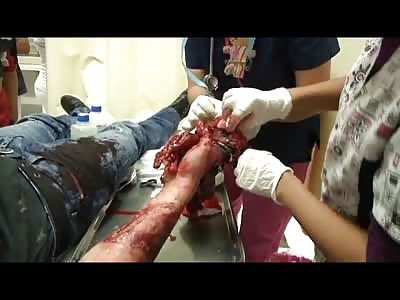 Hospital Workers Work on Mans Hand That Doesn't  Stand a Chance