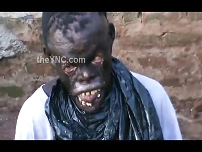 Very Sad Video of Poor Boy who was Doused with Hot Water by his Stepmother, Now he is being Eaten by Fleas (Comments Disabled) 