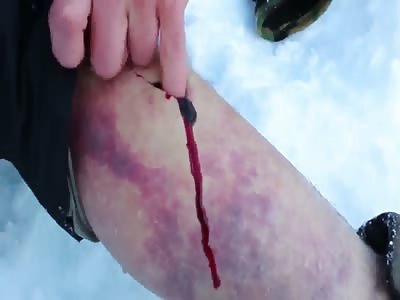 Insane self surgery...Slices  leg open and sticks his fingers in, removing Hematoma!!!!
