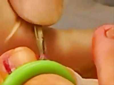 From Start to Finish: Ingrown Toenail Operation