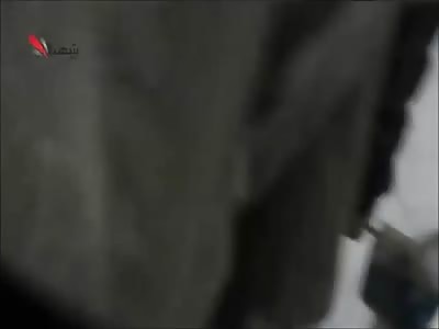 Little girl with a big hole in the chest after being hit by shrapnel