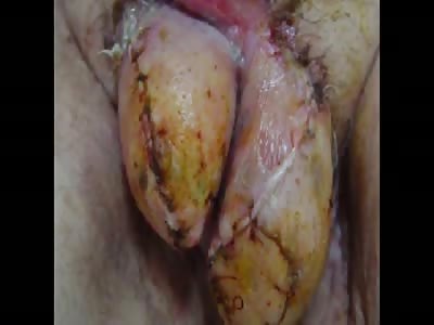 Fournier's Gangrene compilation.