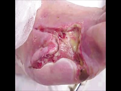 What happens when you don't manage your Diabetes.