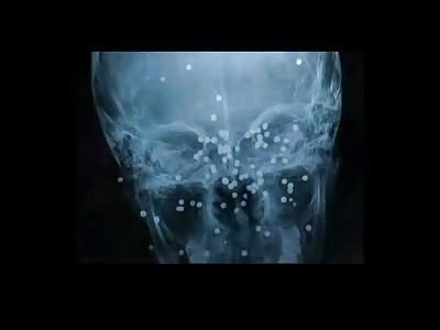 The Results Of Being Shot With A Shotgun