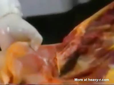 18yr old girl autopsy.