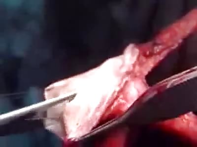 Sex Reassignment Surgery - Male To Female