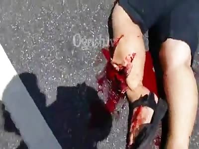 *BRAZIL* Mom and daughter ran over, Mom's got CRUSHED LEG