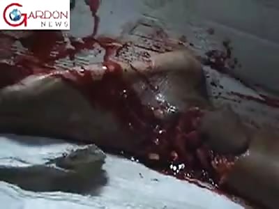 POOR AND CRYING GIRL HAD SHATTERED FOOT IN ACCIDENT