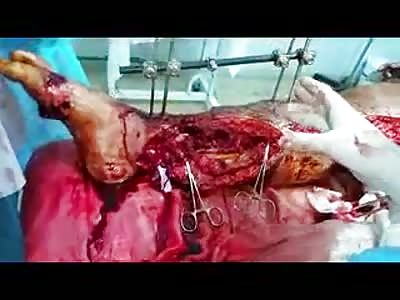 AFTER INJURY IN EXPLOSION, MAN SUFFERS LEGS SURGERY