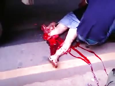 POOR WOMAN HIT BY TRUCK HAS CRUSHED LEG 