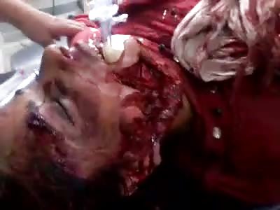 GIRL INJURED IN FACE