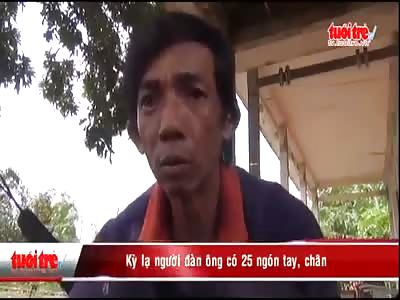 VIETNAMESE MAN HAVE 25 FINGERS