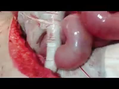 PATIENT WITH SPLEEN RUPTURE ATTENDED IN FIELD HOSPITAL 