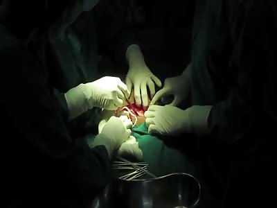 C-section: women prefer it to preserve their vagina's tightness.