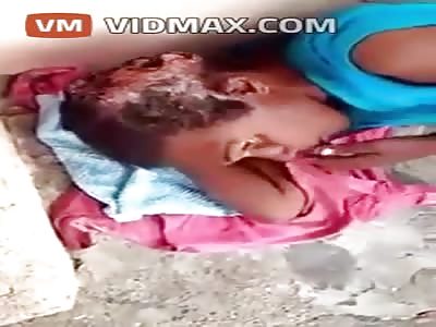  Woman's brain being eaten alive by worms/maggots